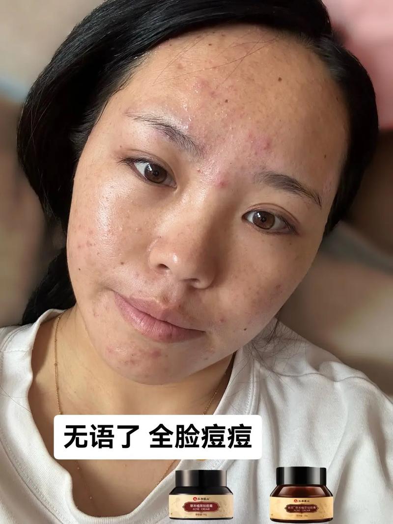 好的容颜离不开控油祛痘