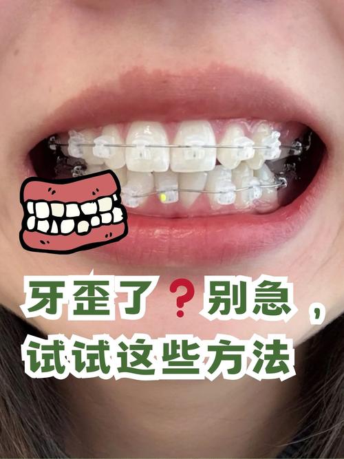 牙齿正畸步骤