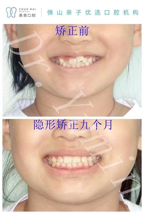 牙齿正畸步骤