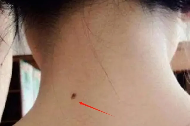 脸痣相图解大全女