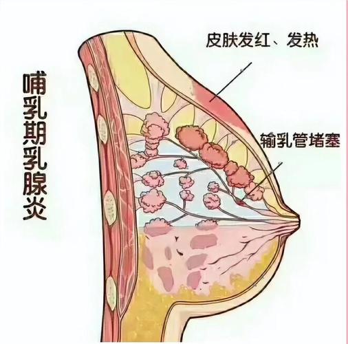 哺乳期乳腺炎怎么办