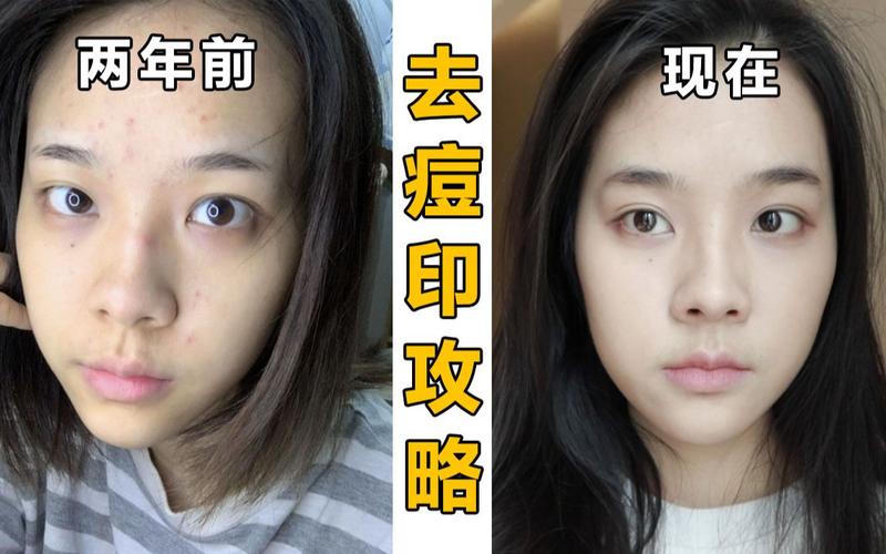 什么方法去痘印最简单有效？